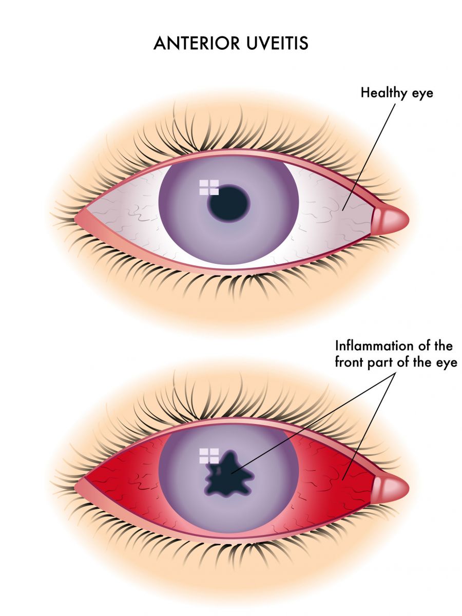 Uveitis |Eye Infection Treatment|Causes & Symptoms Singapore